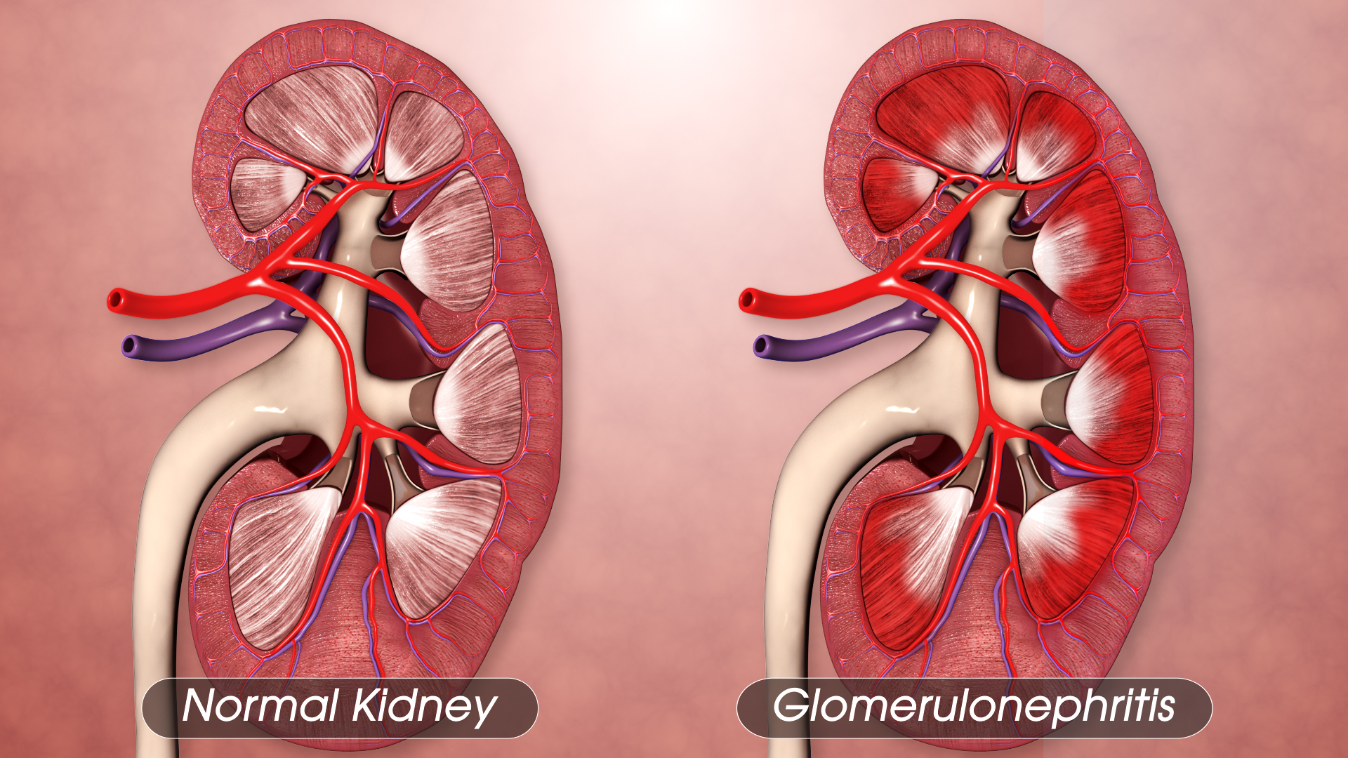 Glomerulonephritis: Advanced Diagnostic and Treatment Approaches